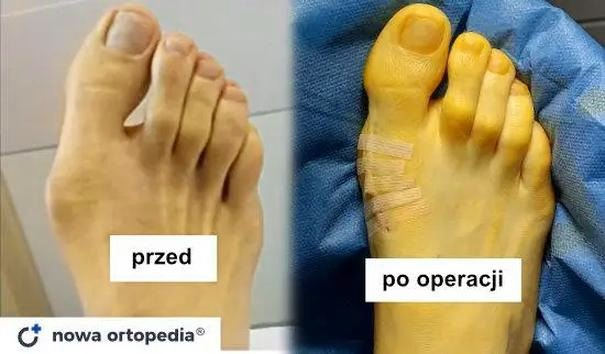 Operacja na haluksy – ile zwolnienia lekarskiego po zabiegu?