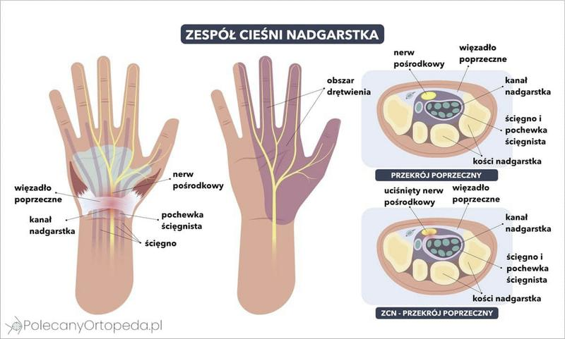 Cieśń nadgarstka