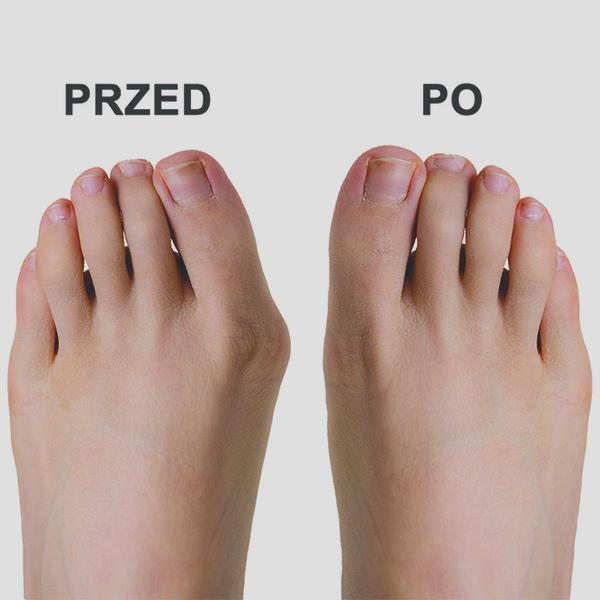 Rekonwalescencja po operacji haluksa