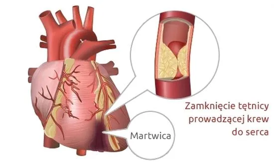 Zwolnienie lekarskie po zawale serca